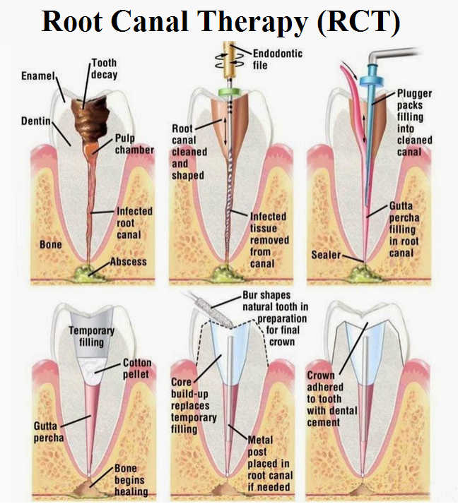 Image result for root canal treatment
