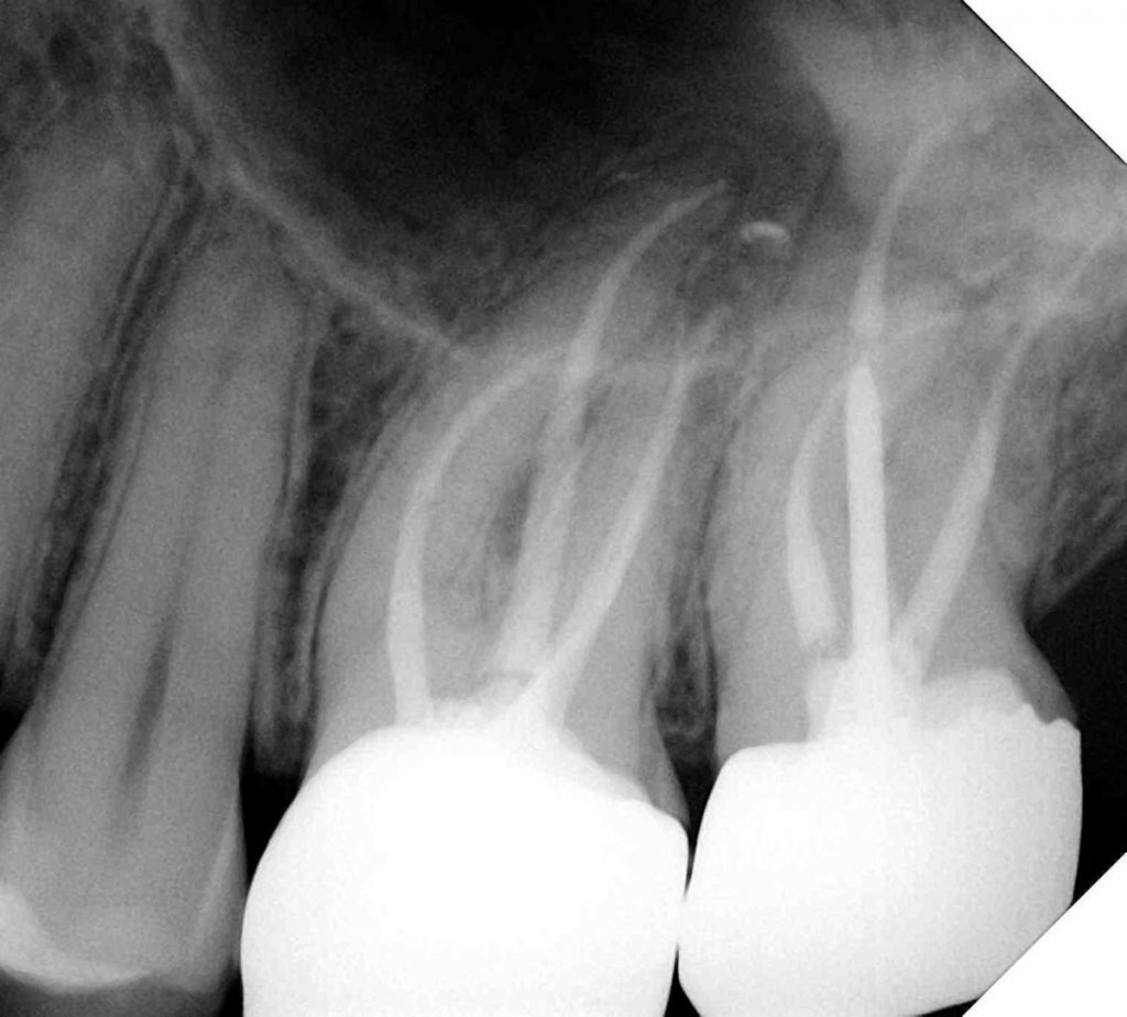 xray after a root canal