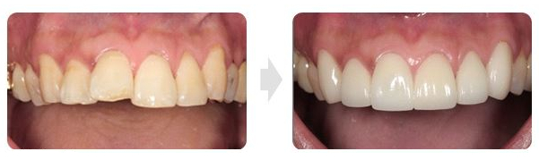 before and after veneer patient