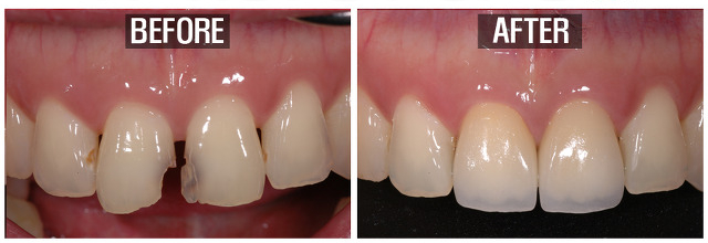 before and after of veneer patient