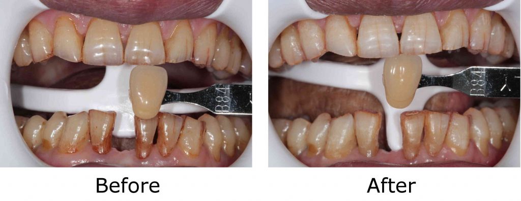 before and after whitening patient