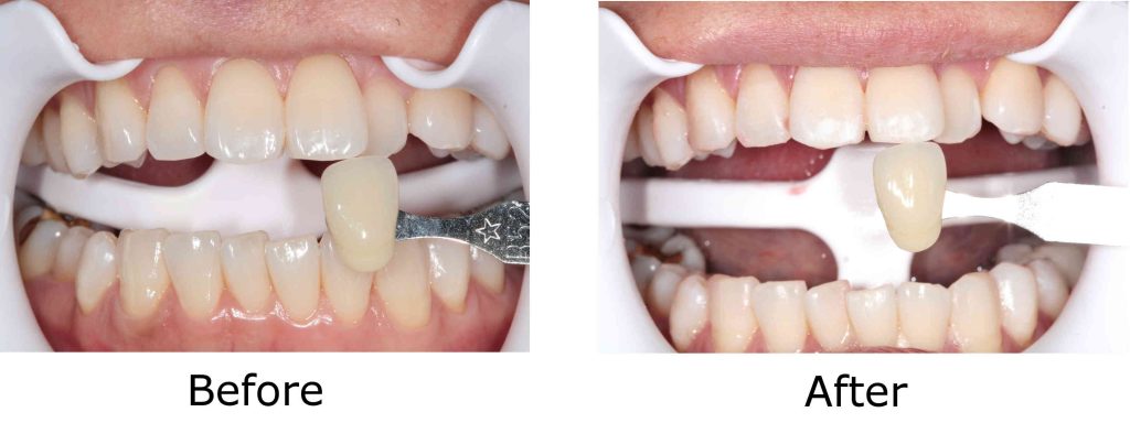 before and after whitening patient