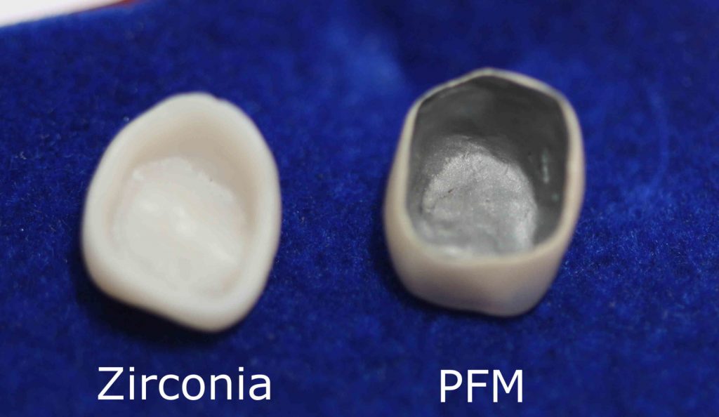 comparison of a Zirconia and PFM crown