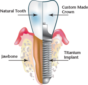 Dental implant cross section