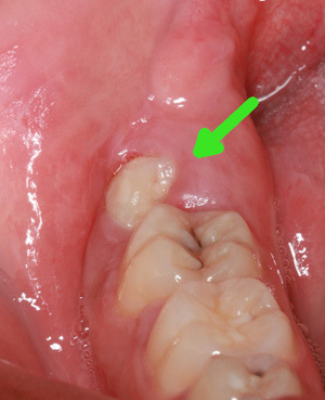 Pericoronitis partially covered wisdom tooth